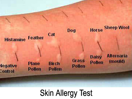 allergy skin test