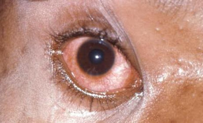 Nodule Of Gonorrhea