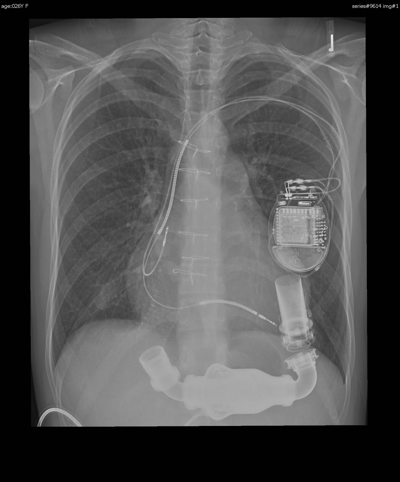 Lvad Driveline