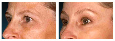 Endoscopic Brow Lift