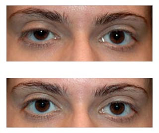 Brow Lift Before And After