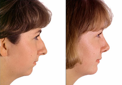 Chin Augmentation Before After