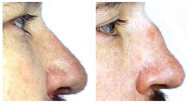 Rhinoplasty Before And After