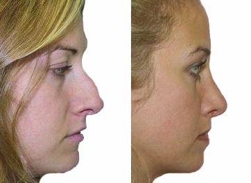Rhinoplasty Before And After