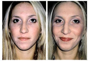 Nose Jobs Before After