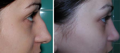 Rhinoplasty Pictures