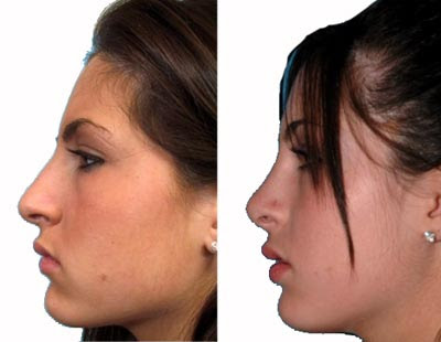 Rhinoplasty Before After