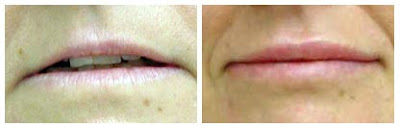 Lip Augmentation Before And After