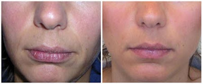 Lip Fillers Pictures
