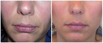 Lip Injections Toronto