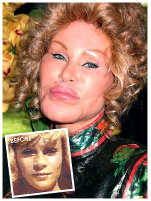Nose Jobs Gone Wrong lady gaga nose job photos. Nose Jobs Gone Wrong