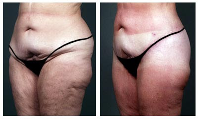 Women+abs+before+and+after