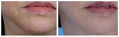 Scar Removal