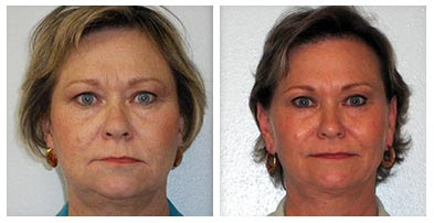 Mesotherapy Before And After
