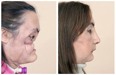 Connie Culp Before After