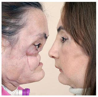 Connie Culp Before And After