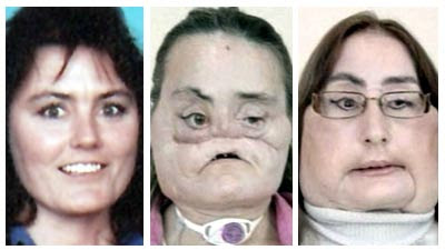 Connie Culp Before And After
