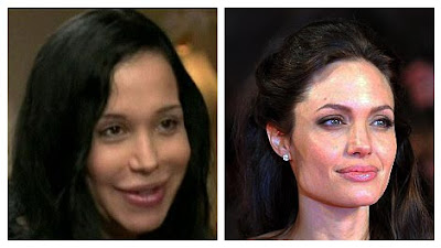 Nadya Suleman Plastic Surgery