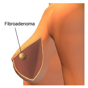 Fibroadenoma