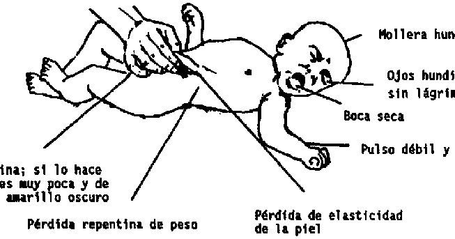 desnutricion: desnutricion:sintomas y tratamiento desnutricion: desnutricion:sintomas y tratamiento