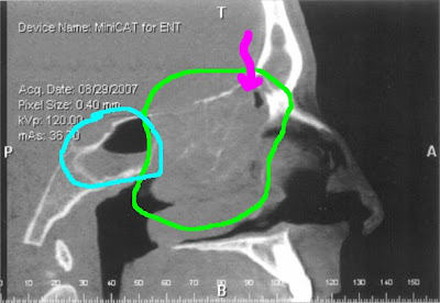 Ct+scan+sinus+polyps