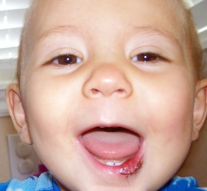 Smith Family Happenings Poor Oliver's Busted Lip!!!