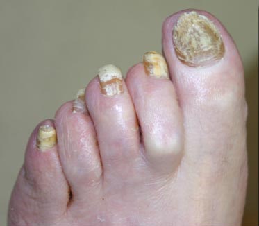 Nail Fungus Pictures Nail Fungus Pictures