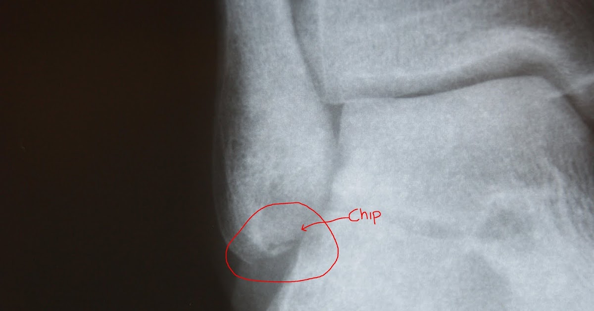 Clean Up Set Bone chip.........Ouch!