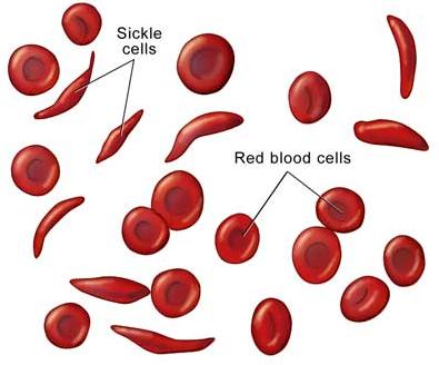 http://4.bp.blogspot.com/_ZGizaOwDSLM/TNuZGFau_-I/AAAAAAAAAwU/UaV4MtpHMms/s1600/sickle_cell_anemia2.jpg