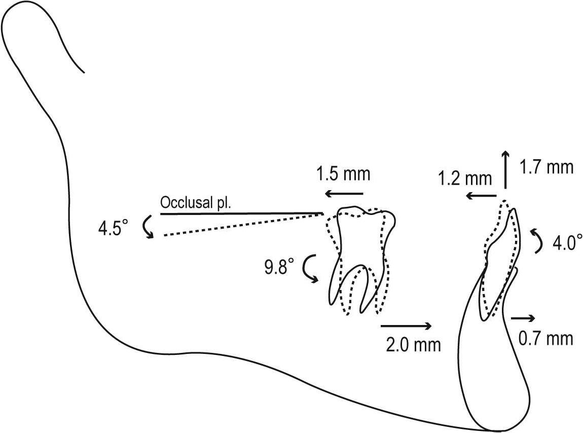 ORTODONTIA CONTEMPORÂNEA Tratamento da Classe lll em adultos utilizando aparelho extrabucal J