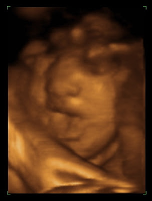 3d ultrasound pictures of twins. 3d ultrasound 20 weeks