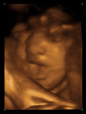 3d ultrasound 20 weeks 3d ultrasound pictures of twins. 3d ultrasound 20 weeks