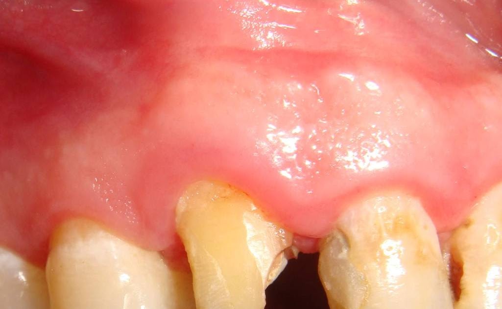 foudaclinic Crown lengthening to treat violation of biologic width