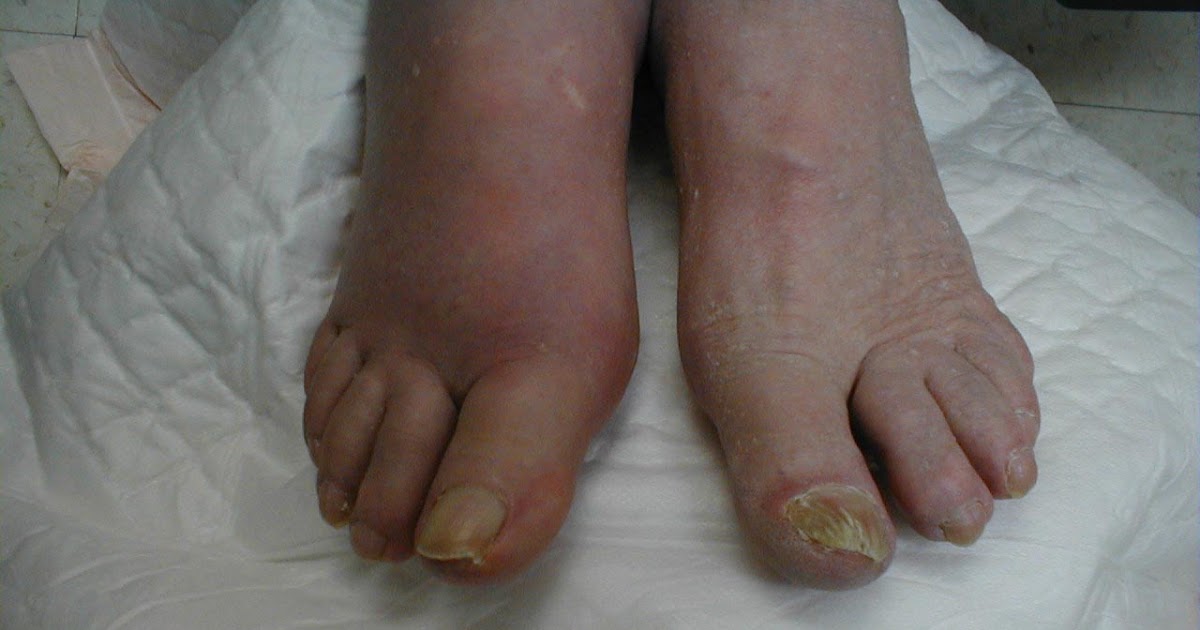 ORTHOPAEDICS CRYSTAL DEPOSITION DISEASE