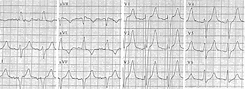 hyperkalemia changes