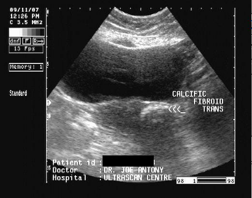 Ultrasound Pedunculated Fibroid