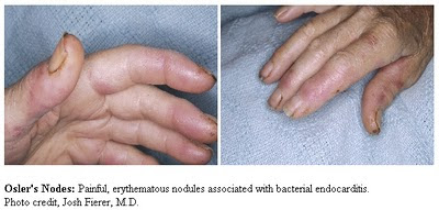 osler nodes