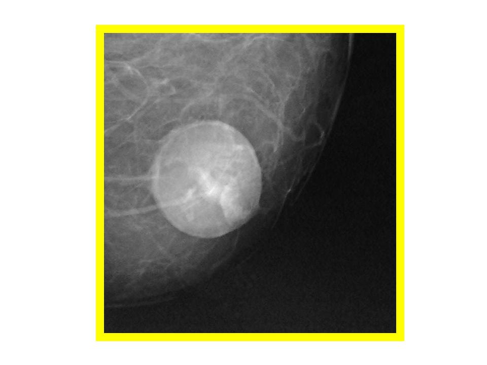 fat cyst