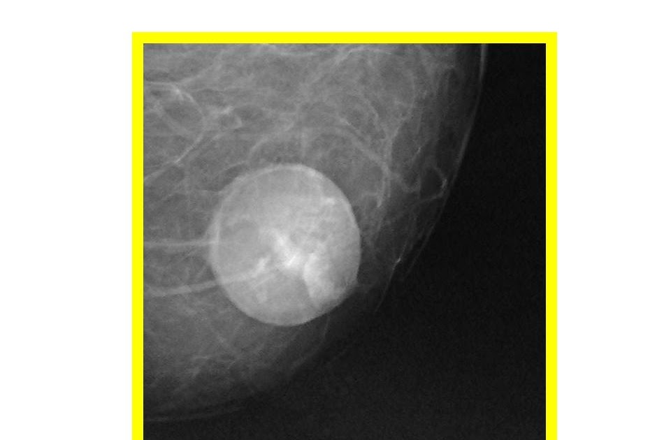 Doctors Gates Oil Cyst or Fat necrosis