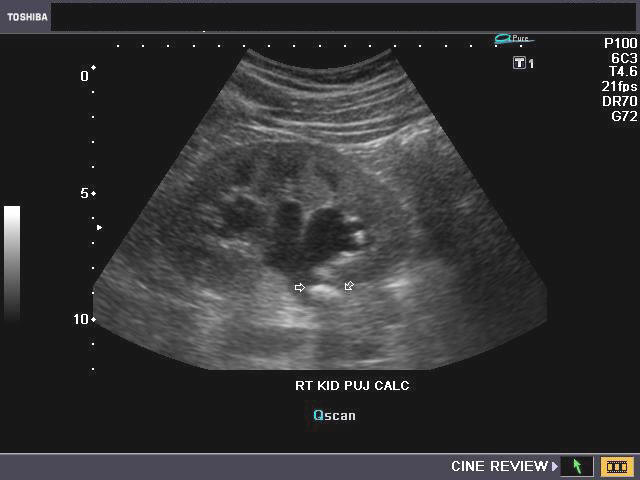Renal Ultrasound Hydronephrosis