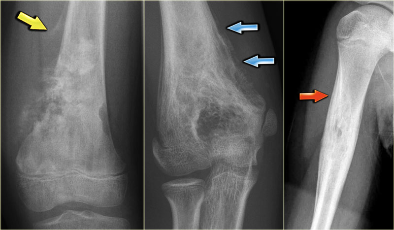 Bone Fracture Types-4.bp.blogspot.com In these X-Rays: