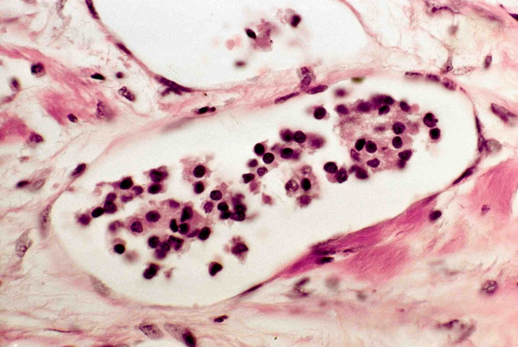 One of these types, follicular