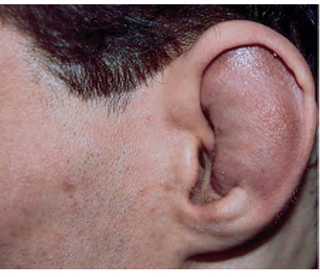 ear hematoma drain at home image gallery pinna hematoma ear hematoma drain at home image gallery pinna hematoma