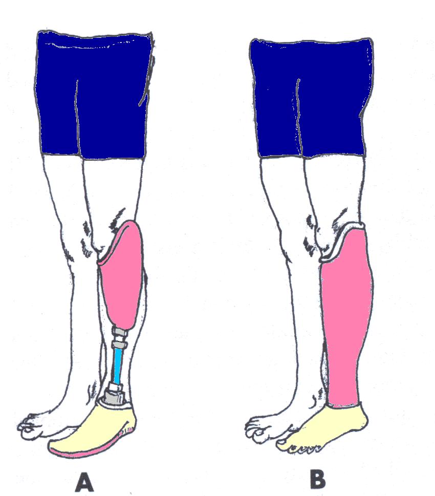 [amputacion+transtibial.jpg]