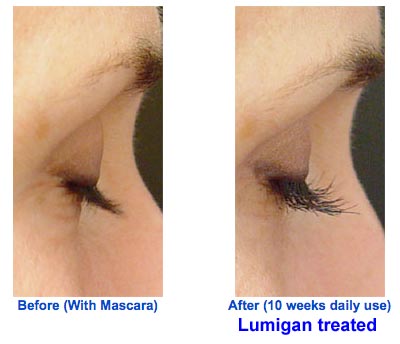 [Lumigan-treated.jpg]