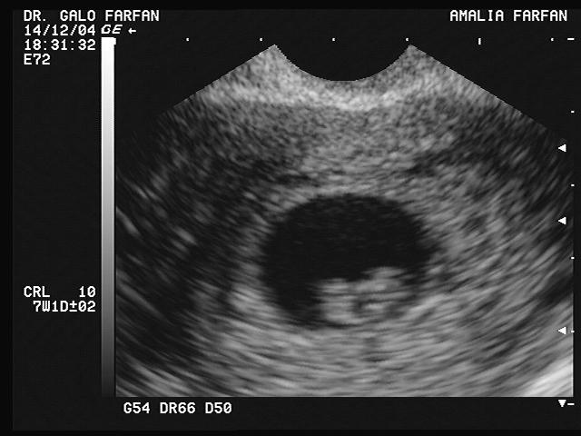 Ecografia de embarazo de 2 meses de gestacion - Imagui