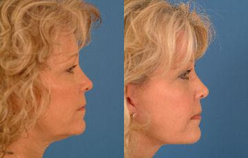 Facelift (Rhytidectomy) before and after
