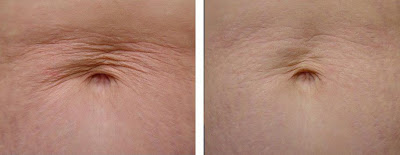 Laser skin tightening before after