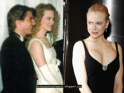 nicole kidman nose job