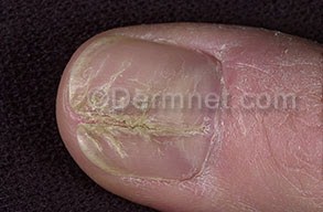 Si ayudará el yodo al tratamiento del hongo de las uñas